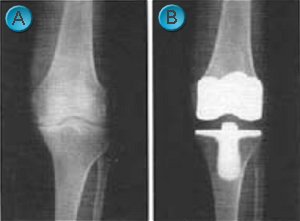 Αρθρίτιδα γόνατος – Ολική αρθροπλαστική γόνατος
